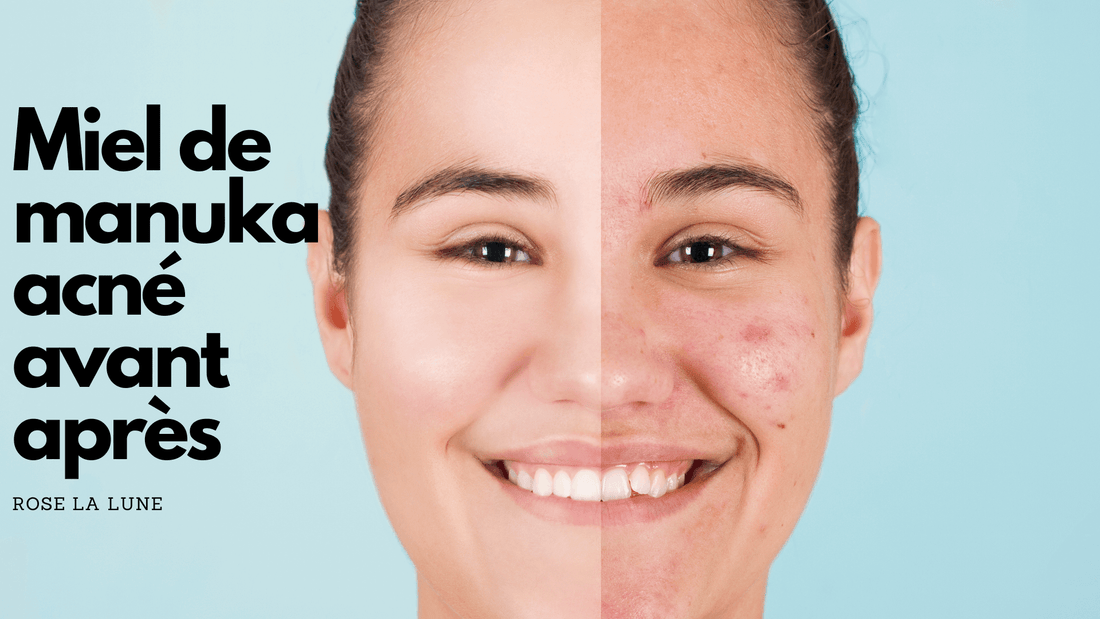 Miel de manuka acné avant apres