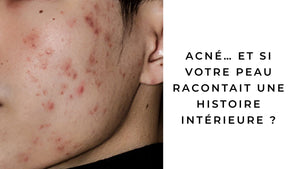 Acné… et si votre peau racontait une histoire intérieure ?