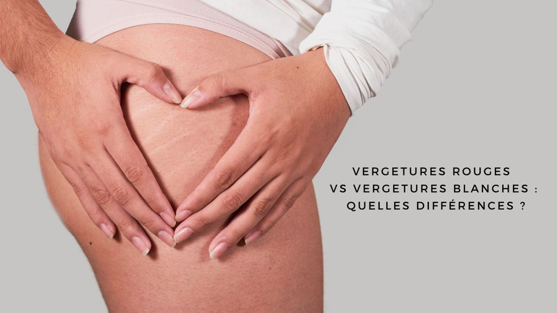 Vergetures rouges vs vergetures blanches : quelles différences ?