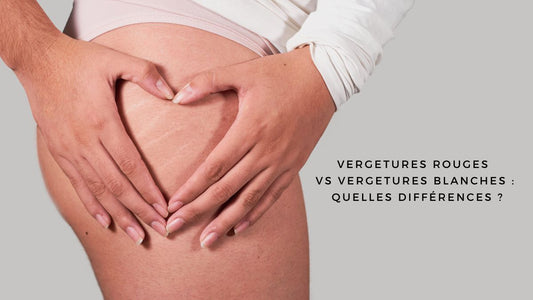 Vergetures rouges vs vergetures blanches : quelles différences ?
