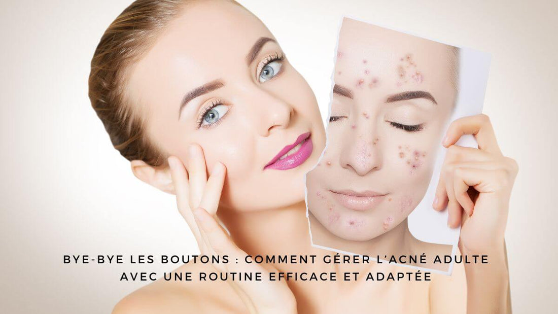 Bye-bye les boutons : comment gérer l’acné adulte avec une routine efficace et adaptée