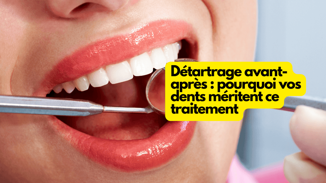 Détartrage avant-après : pourquoi vos dents méritent ce traitement