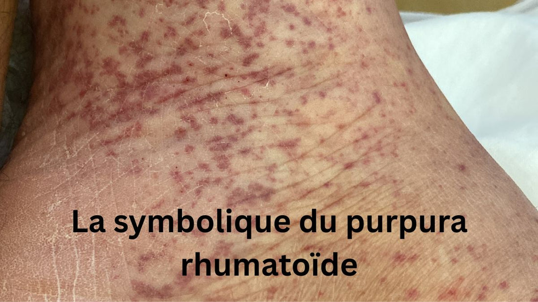 La symbolique du purpura rhumatoïde : quand le corps dessine ses propres messages